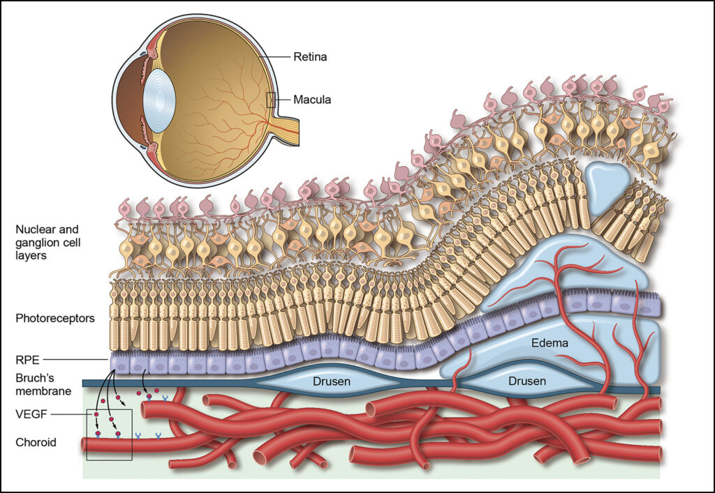 A medical illustration depicting exudative macular degeneration of the eye.