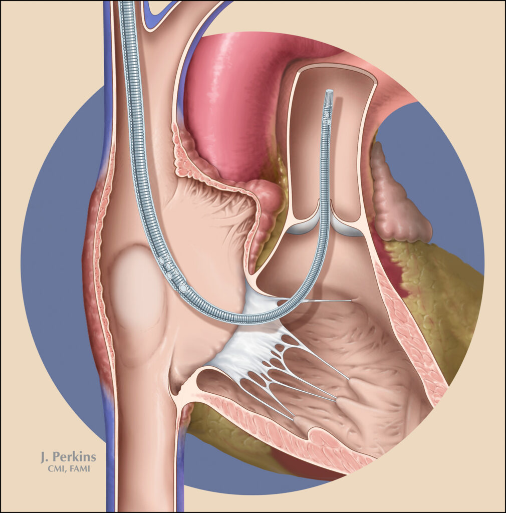 A medical illustration depicting a pulmonary catheter inserted.